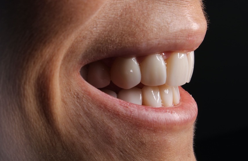 Prótesis dental fija