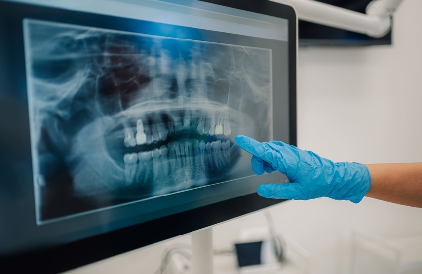 Implantes dentales cigomáticos