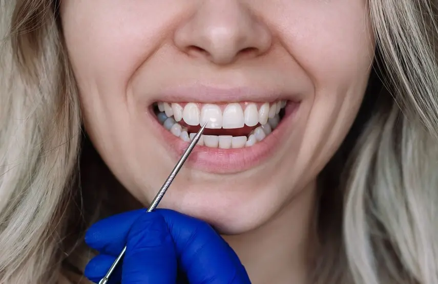Manchas en los dientes
